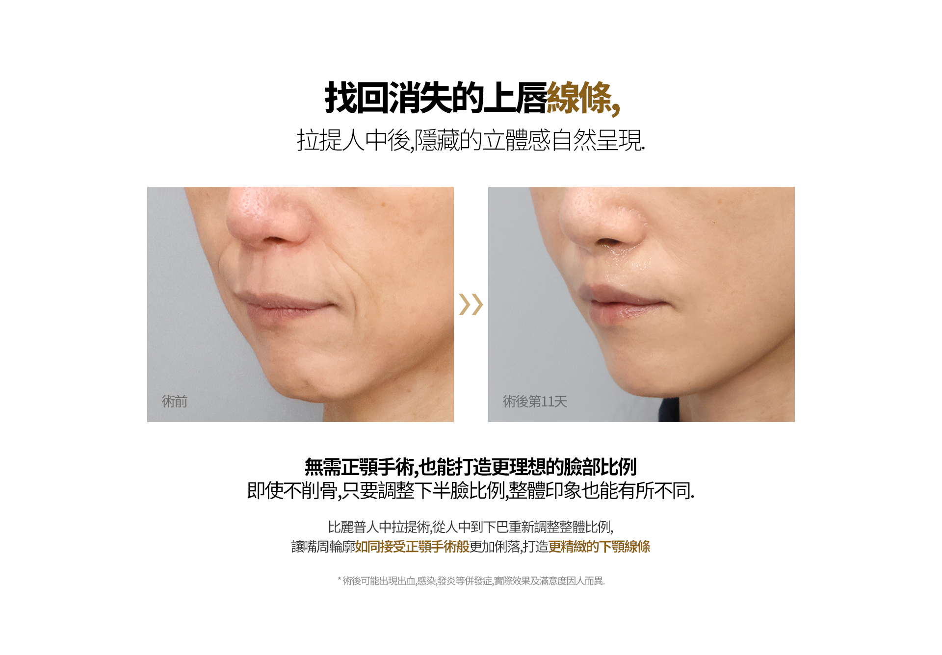 找回消失的上唇线条， 提升人中，让隐藏的立体感重新显现。 无需正颌手术，也能改善面部比例 即使不进行削骨手术，通过调整下半脸比例，也能改变整体面部印象。 比丽普人中提升术，重新调整从人中到下巴的整体比例， 使嘴周轮廓如同接受正颌手术般更加利落清晰，塑造更精致流畅的下颌线条。 ※ 术后可能出现出血、感染、炎症等并发症，实际效果及满意度因人而异。