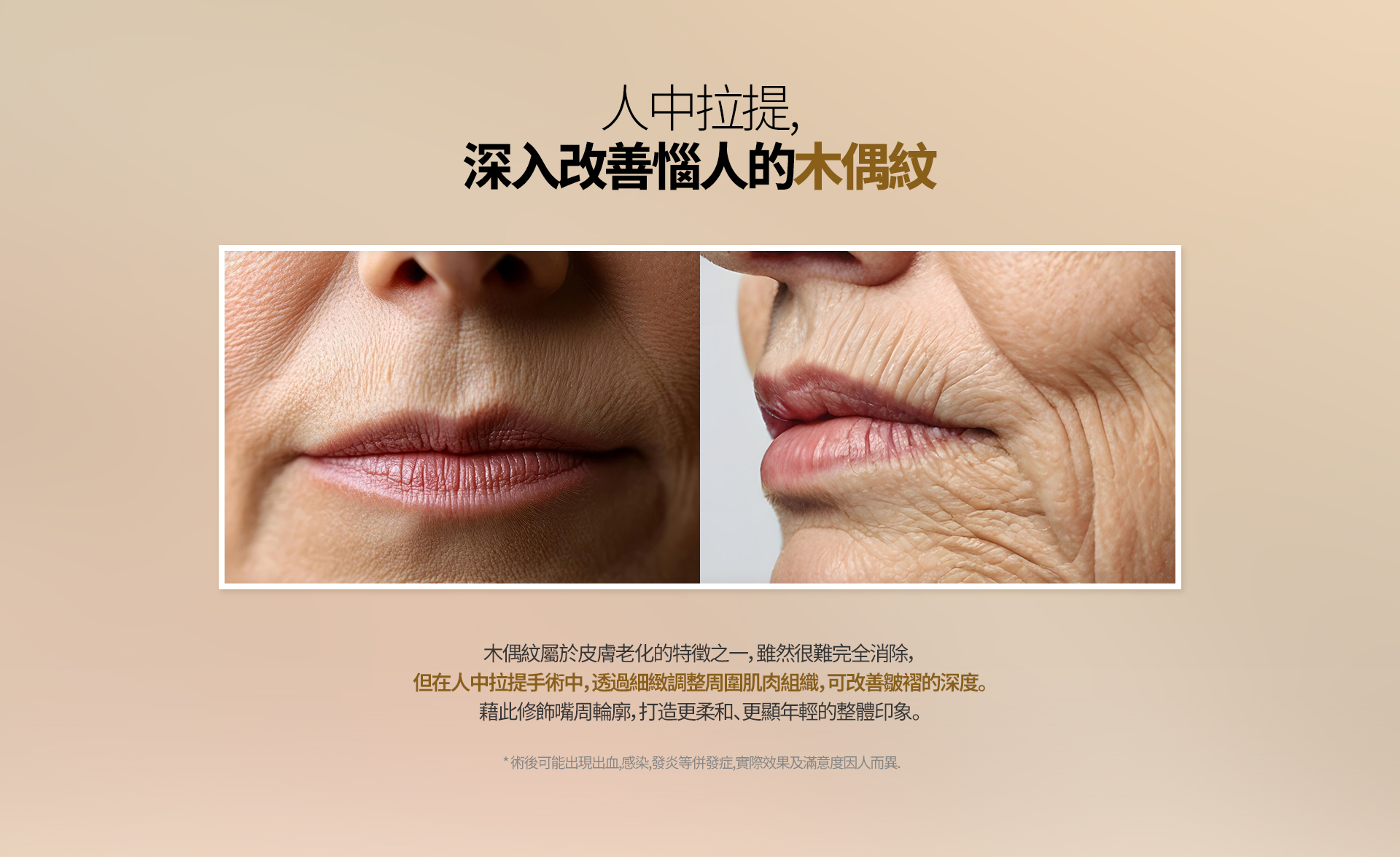人中提升， 深入改善明显的木偶纹 木偶纹属于皮肤老化的表现之一，虽然很难完全消除， 但在人中提升手术过程中，通过精细调整周围肌肉组织，可以改善皱纹的深度。 从而修饰嘴周轮廓，塑造更加柔和、年轻的面部印象。 ※ 术后可能出现出血、感染、炎症等并发症，实际效果及满意度因人而异。