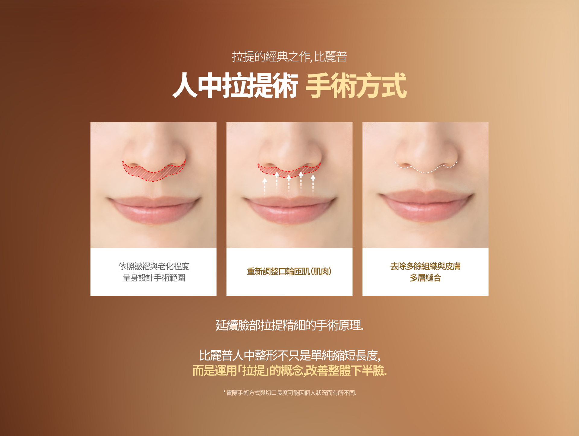 提升领域的经典之作，比丽普 人中提升术 手术方法 根据皱褶及老化程度 设计适合个人情况的手术范围 重新调整 口轮匝肌（肌肉） 去除多余组织及皮肤 进行多层缝合 延续面部提升精细的手术原理。 比丽普人中整形并非单纯缩短长度， 而是运用“提升”的原理，改善整个下半脸。 ※ 实际手术方式及切口长度可能因个人情况而有所不同。