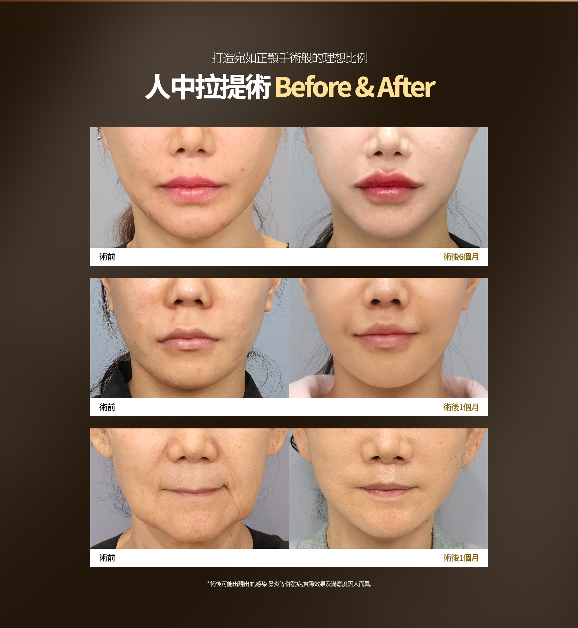 打造如同正颌手术般协调的面部比例 人中提升术 Before & After 术前 术后6个月 术前 术后1个月 術前 术后1个月 ※ 术后可能出现出血、感染、炎症等并发症，实际效果及满意度因人而异。