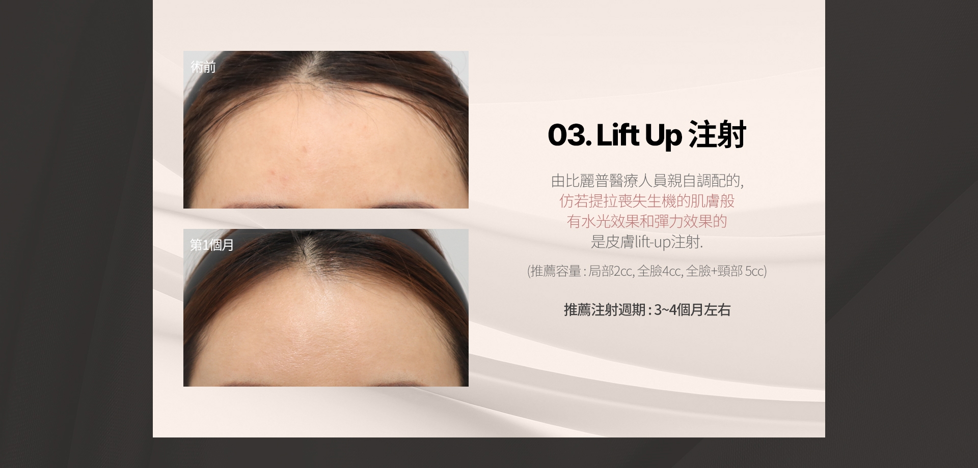 03. Lift Up 注射 由比麗普醫療人員親自調配的、仿若提拉喪失生機的肌膚般 有水光效果和彈力效果的 是皮膚lift-up注射。推薦容量: 局部2cc，全臉4cc，全臉+頸部 5cc 推薦注射週期: 3~4個月左右