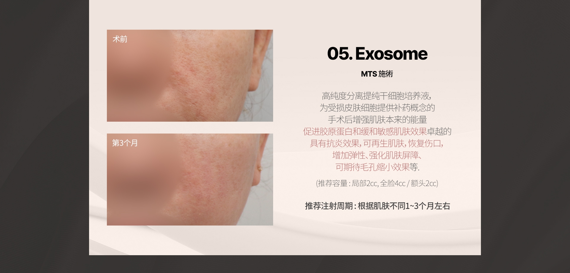 05. Exosome MTS 施術 高純度分離提純幹細胞培養液， 爲受損皮膚細胞提供補藥概念的 手術後增強肌膚本來的能量 促進膠原蛋白和緩和敏感肌膚效果卓越的 具有抗炎效果，可再生肌膚，恢復傷口， 增加彈性、強化肌膚屏障、 可期待毛孔縮小效果等。推薦容量: 局部2cc，全臉4cc / 額頭2cc 推薦注射週期: 根據肌膚不同1~2個月左右