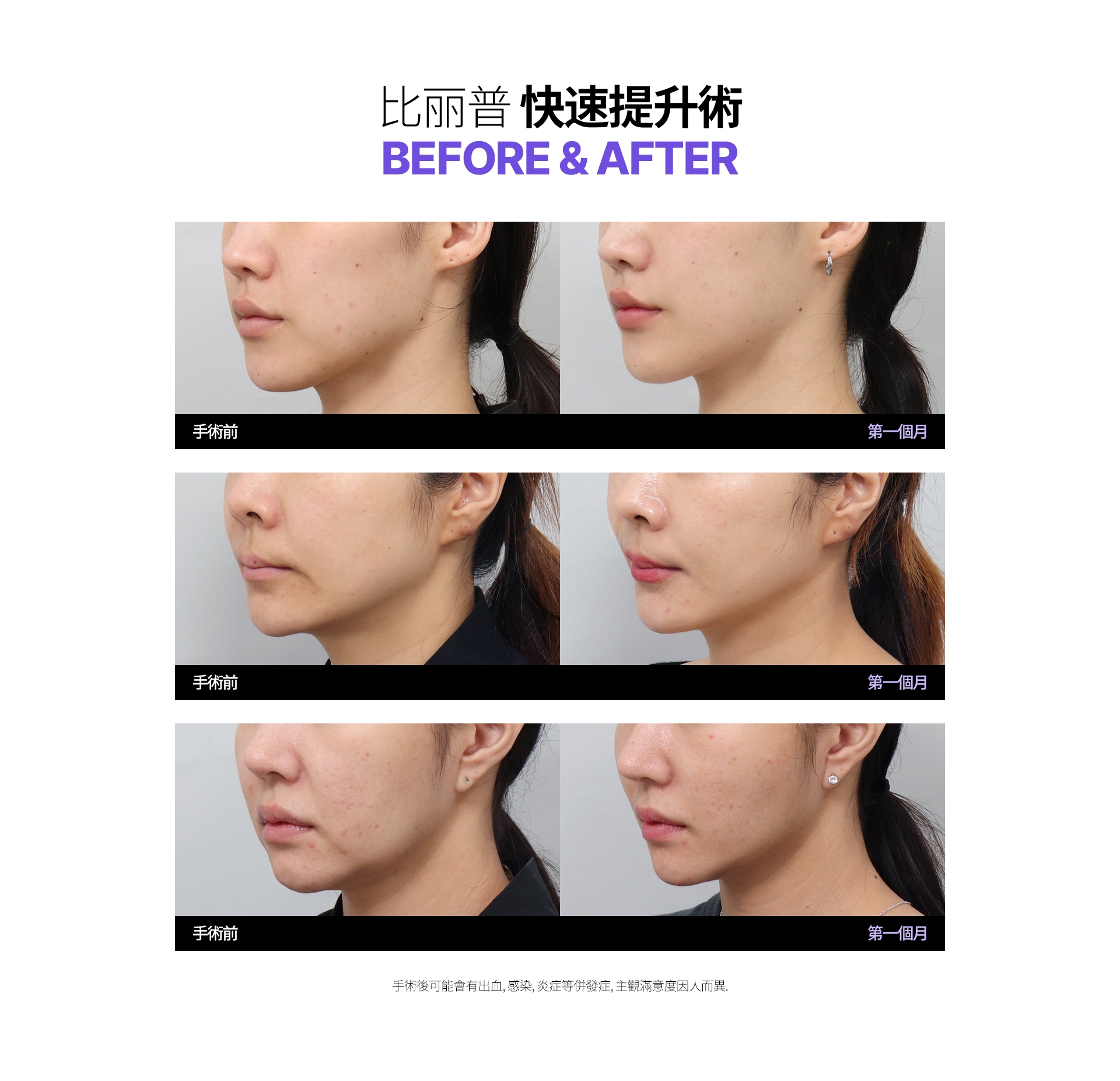 比丽普 快速提升術 BEFORE & AFTER 手術後可能會有出血、感染、炎症等併發症，主觀滿意度因人而異。