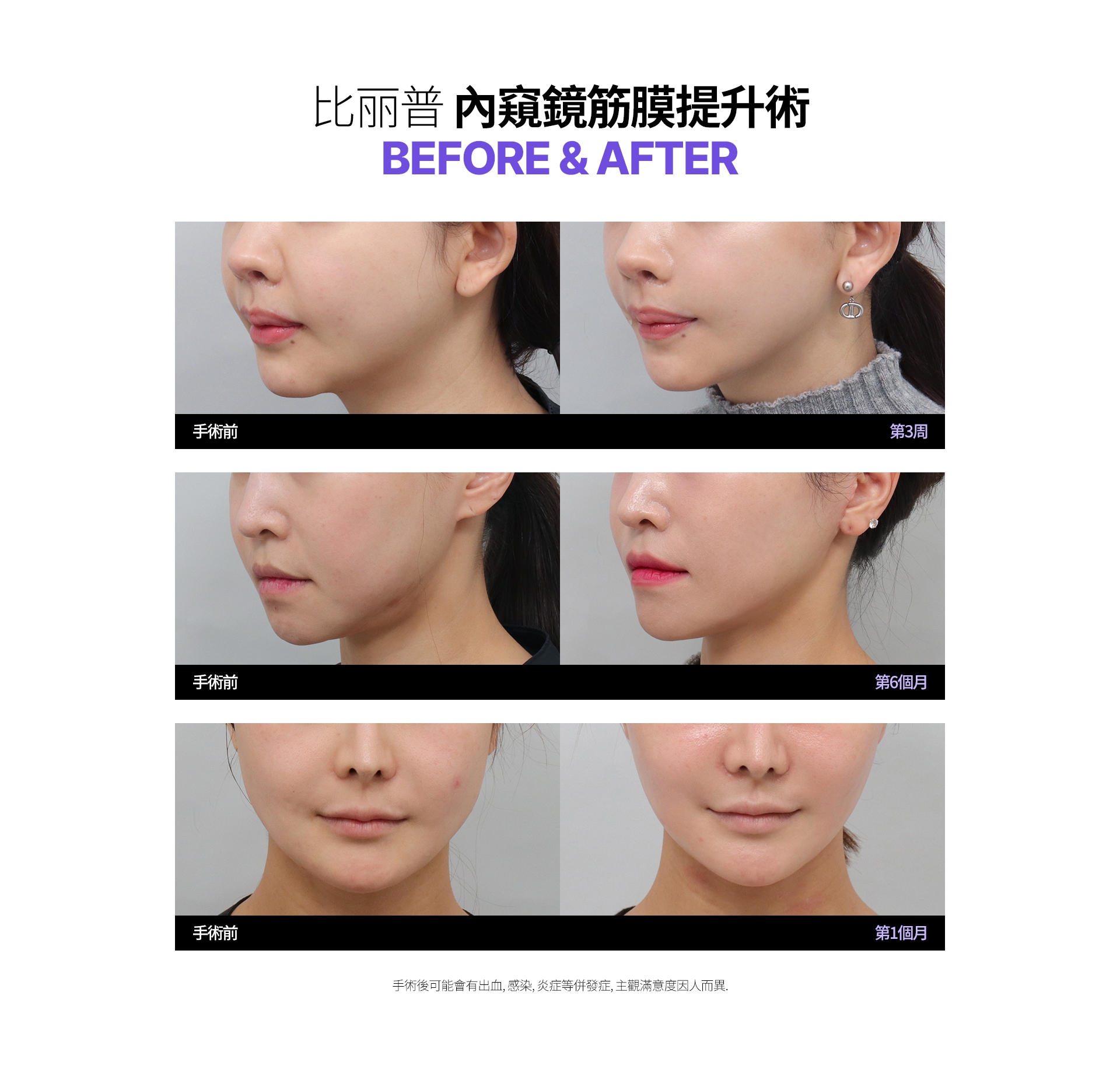 比丽普 內窺鏡筋膜提升術 BEFORE &AFTER 手術後可能會有出血、感染、炎症等併發症，主觀滿意度因人而異。