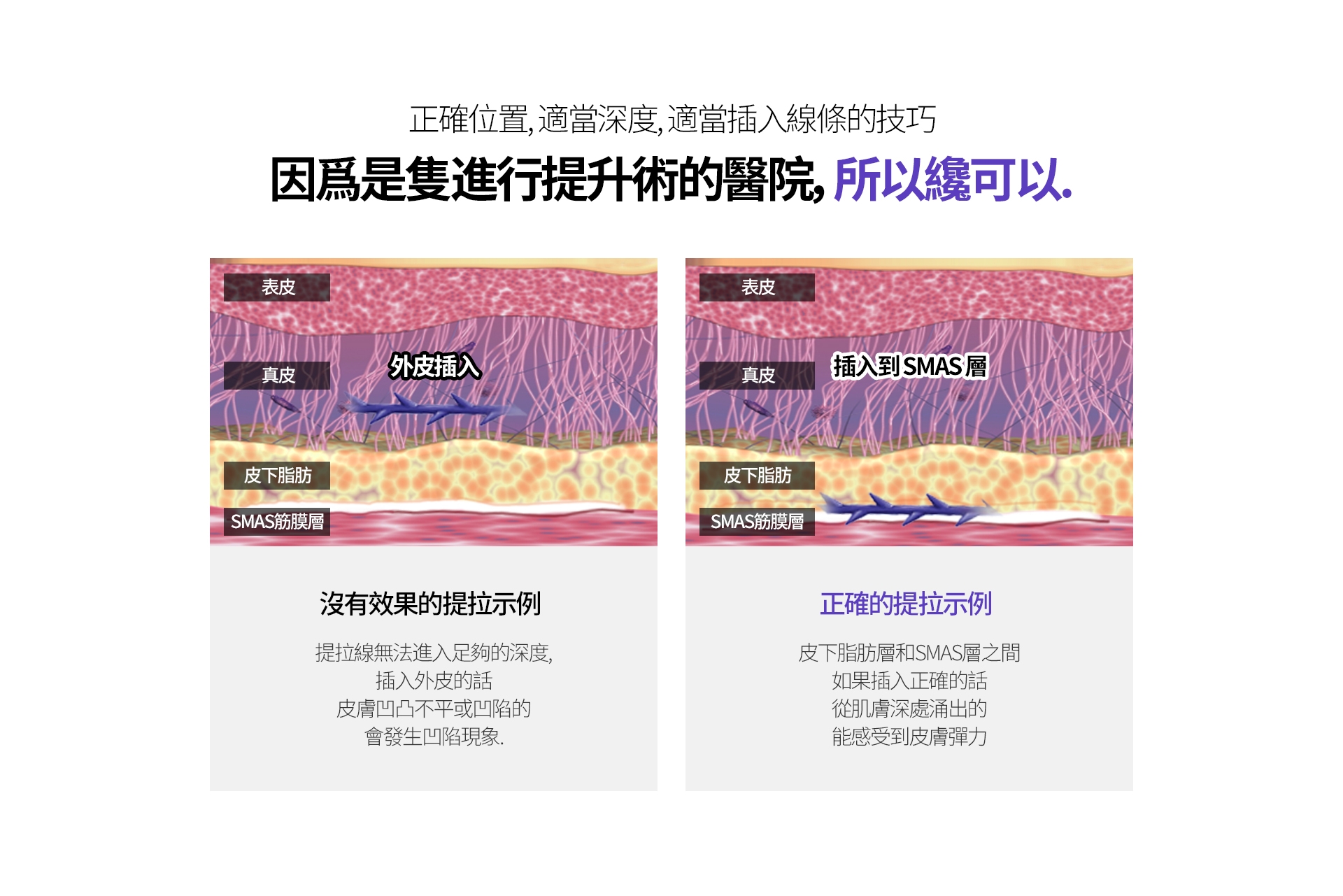 正確位置、適當深度、適當插入線條的技巧 因爲是隻進行提升術的醫院，所以纔可以。 沒有效果的提拉示例 提拉線無法進入足夠的深度，插入外皮的話 皮膚凹凸不平或凹陷的 會發生凹陷現象 正確的提拉示例 皮下脂肪層和SMAS層之間 如果插入正確的話 從肌膚深處涌出的 能感受到皮膚彈力