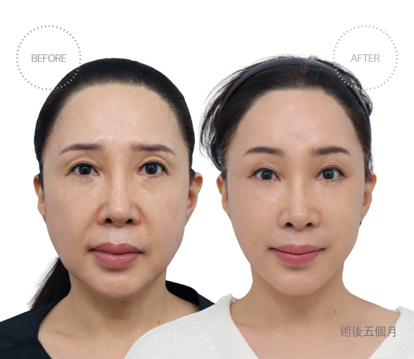 術後五個月