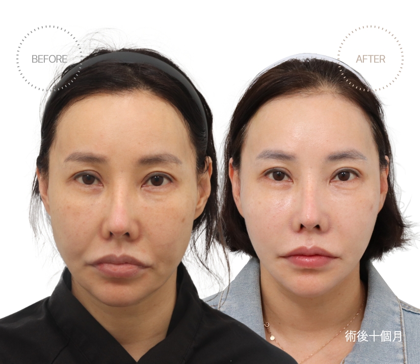 術後十個月