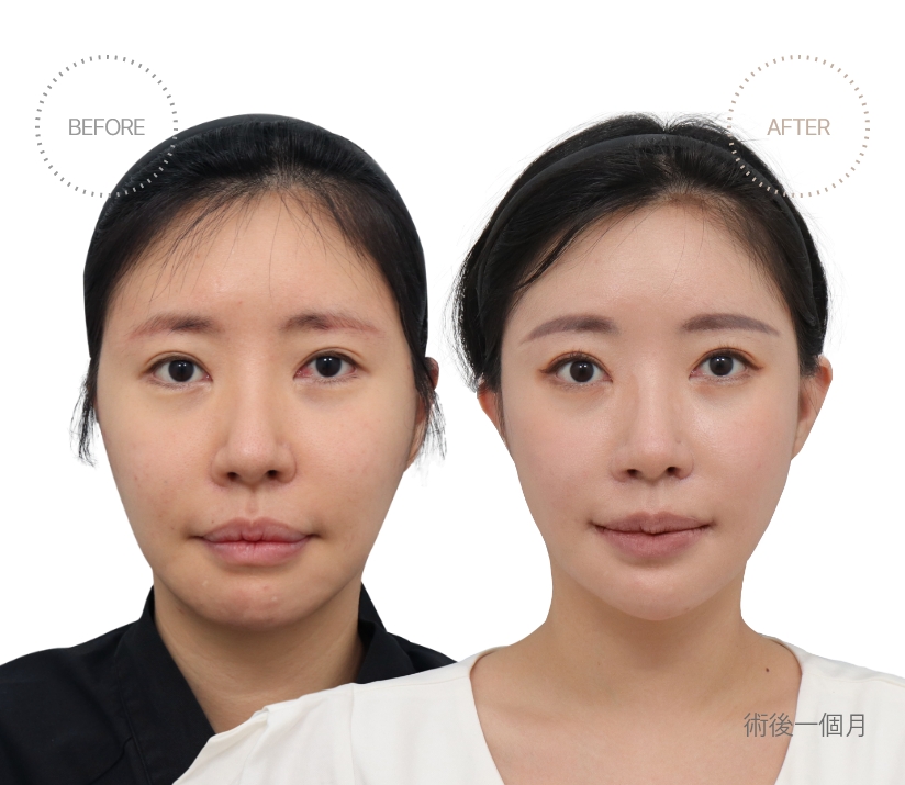 術後一個月