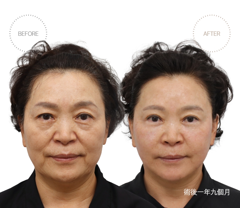 術後一年九個月