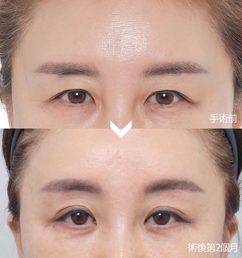 手術 前 - 術後第2個月