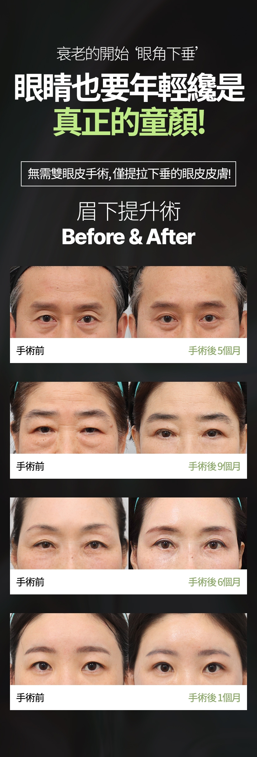 衰老的開始 眼角下垂 眼睛也要年輕纔是真正的童顏 無需雙眼皮手術，僅提拉下垂的眼皮皮膚！ 眉下提升術 Before & After / 手術 前 - 手術後 5個月