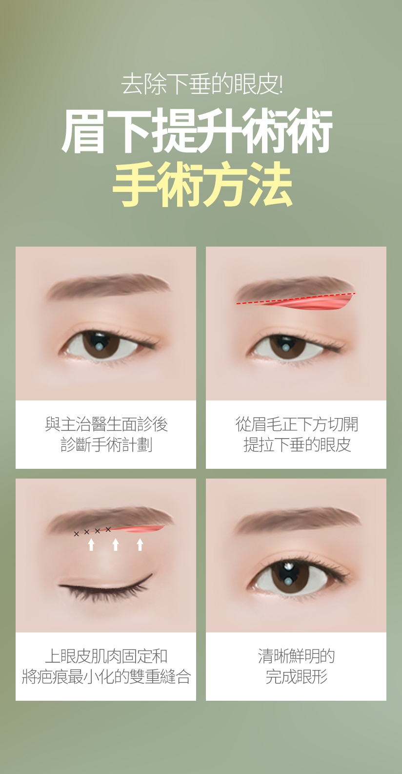 去除下垂的眼皮！ 眉下提升術術 手術方法 與主治醫生面診後 診斷手術計劃 從眉毛正下方切開 提拉下垂的眼皮 上眼皮肌肉固定和 將疤痕最小化的雙重縫合 清晰鮮明的 完成眼形