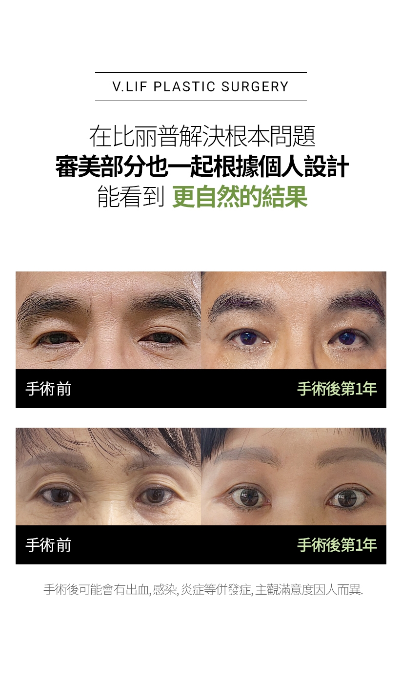 在比丽普解決根本問題，審美部分也一起根據個人設計 能看到更自然的結果 手術 前 - 手術後第1年 / 手術 前 - 手術後第1年