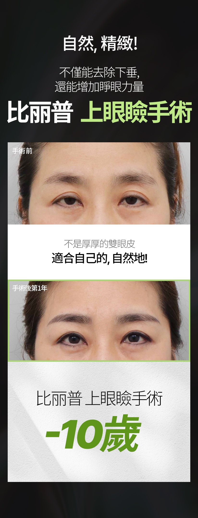 自然、精緻！ 不僅能去除下垂，還能增加睜眼力量 比丽普 上眼瞼手術 不是厚厚的雙眼皮 適合自己的，自然地！ 比丽普 上眼瞼手術 -10歲 