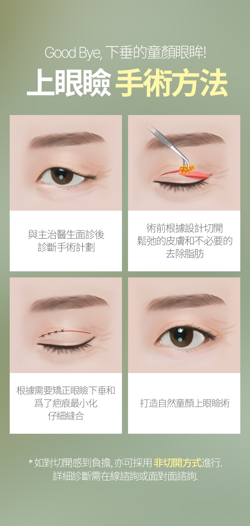 Good Bye ，下垂的童顏眼眸！ 上眼瞼 手術方法 與主治醫生面診後 診斷手術計劃 術前根據設計切開 鬆弛的皮膚和不必要的 去除脂肪 根據需要矯正眼瞼下垂和 爲了疤痕最小化 仔細縫合 打造自然童顏上眼瞼術 *如對切開感到負擔，亦可採用非切開方式進行。詳細診斷需在線諮詢或面對面諮詢。