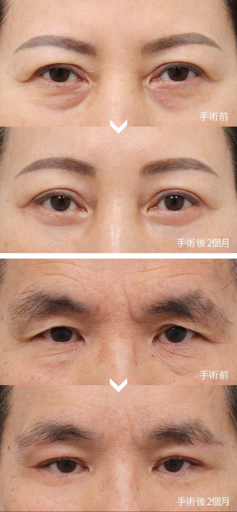 手術 前 - 手術 後 2個月 / 手術 前 - 手術 後 2個月