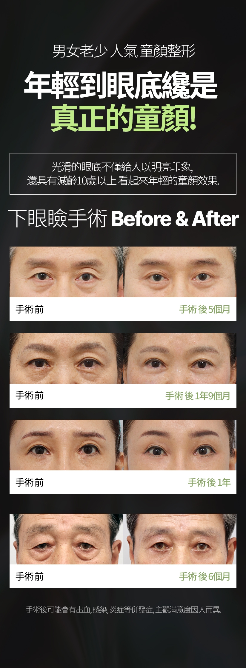 男女老少 人氣 童顏整形 年輕到眼底纔是 真正的童顏！ 光滑的眼底不僅給人以明亮印象，還具有減齡10歲以上 看起來年輕的童顏效果。下眼瞼手術 Before & After 手術後可能會有出血、感染、炎症等併發症，主觀滿意度因人而異。