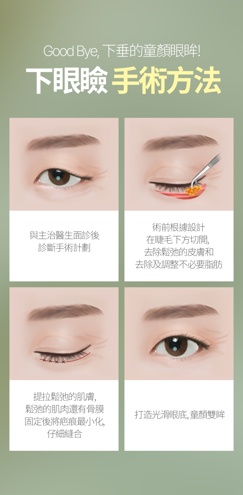Good Bye ，下垂的童顏眼眸！ 下眼瞼 手術方法 與主治醫生面診後 診斷手術計劃 術前根據設計 在睫毛下方切開，去除鬆弛的皮膚和 去除及調整不必要脂肪 提拉鬆弛的肌膚， 鬆弛的肌肉還有骨膜 固定後將疤痕最小化， 仔細縫合 打造光滑眼底、童顏雙眸
