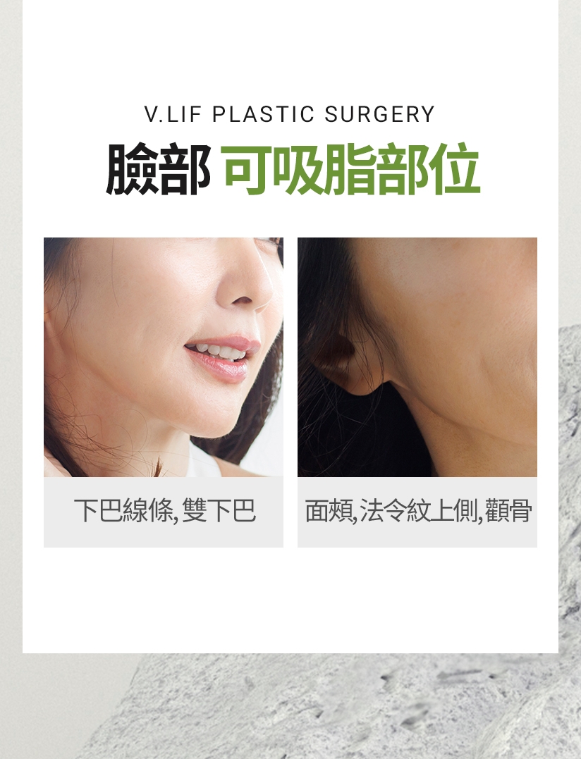 比丽普立體脂肪可填充部位 額頭 眼窩 蘋果肌，法令紋 下巴 *要填充的脂肪採集是從大腿內側、腹部等脂肪較多的身體部分採集。