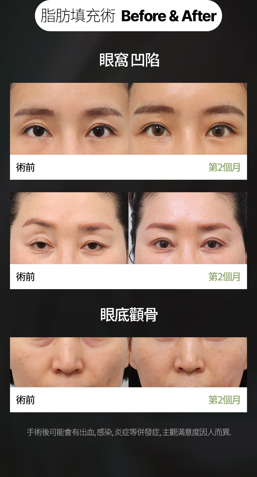 脂肪填充術 Before & After 眼窩 凹陷 術前 第2個月 術前 第2個月 眼底顴骨 術前 第2個月