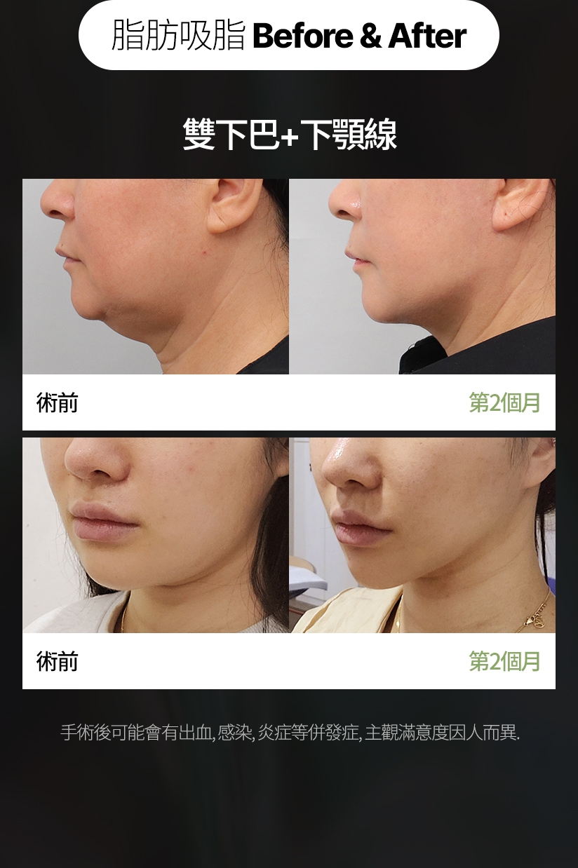 脂肪吸脂   Before & After 雙下巴+下顎線 術前 第2個月 術前 第2個月 手術後可能會有出血、感染、炎症等併發症，主觀滿意度因人而異。