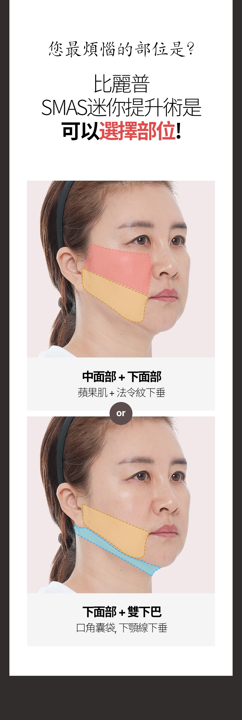 您最煩惱的部位是？比麗普 SMAS迷你提升術是 可以選擇部位！ 中面部+下面部 蘋果肌+法令紋下垂 下面部+雙下巴 口角囊袋，下顎線下垂