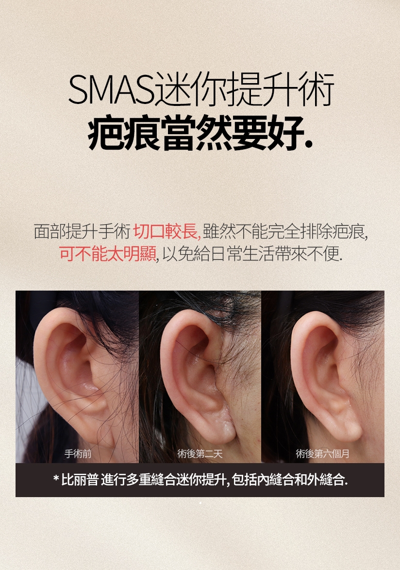 SMAS迷你提升術  疤痕當然要好。面部提升手術切口較長，雖然不能完全排除疤痕， 可不能太明顯，以免給日常生活帶來不便。手術前 術後第二天 術後第六個月 比丽普 進行多重縫合迷你提升，包括內縫合和外縫合。