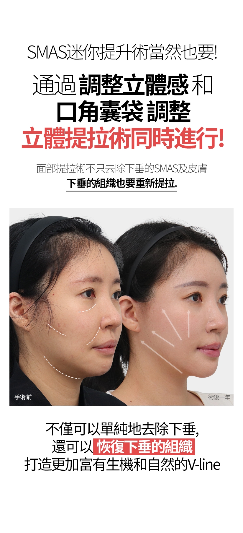 SMAS迷你提升術當然也要！ 通過 調整立體感 和 口角囊袋 調整  立體提拉術同時進行！ 面部提拉術不只去除下垂的SMAS及皮膚， 下垂的組織也要重新提拉。不僅可以單純地去除下垂，還可以恢復下垂的組織。 打造更加富有生機和自然的V-line