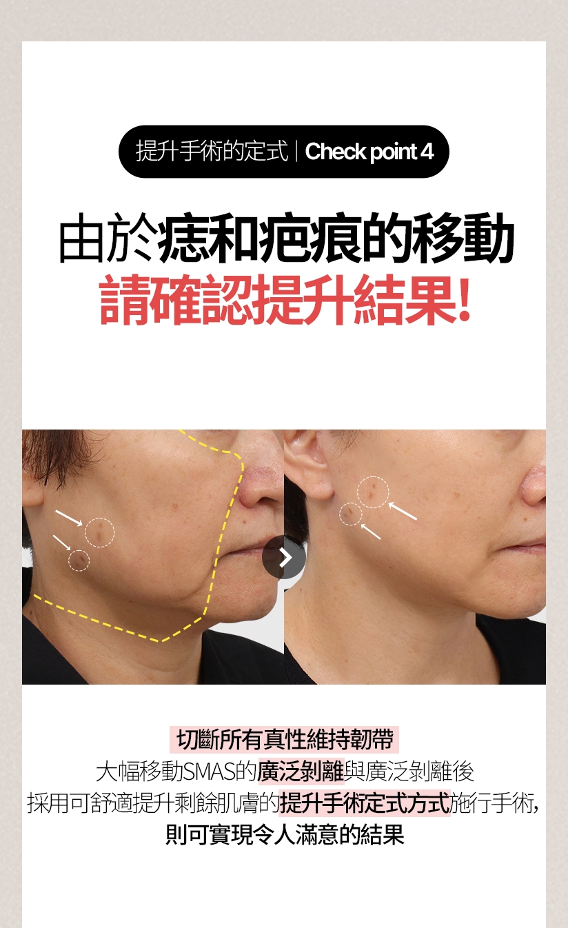 提升手術的定式/ Check point  4 由於痣和疤痕的移動， 請確認提升結果！ 切斷所有真性維持韌帶、大幅移動SMAS的廣泛剝離與廣泛剝離後 採用可舒適提升剩餘肌膚的提升手術定式方式施行手術，則可實現令人滿意的結果