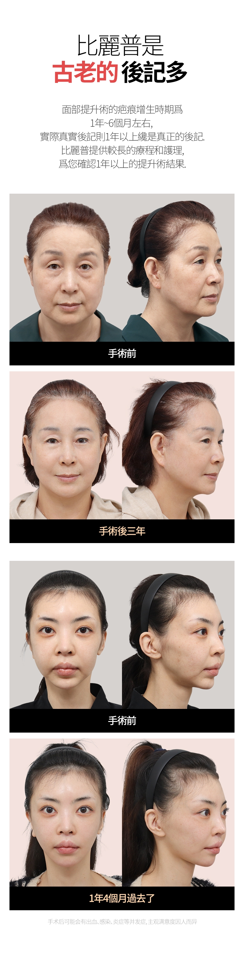 比麗普是 古老的  後記多 面部提升術的疤痕增生時期爲1年~6個月左右, 實際真實後記則1年以上纔是真正的後. 比麗普提供較長的療程和護理, 爲您確認1年以上的提升術結果. 手術後可能會有出血、感染、炎症等併發症，主觀滿意度因人而異