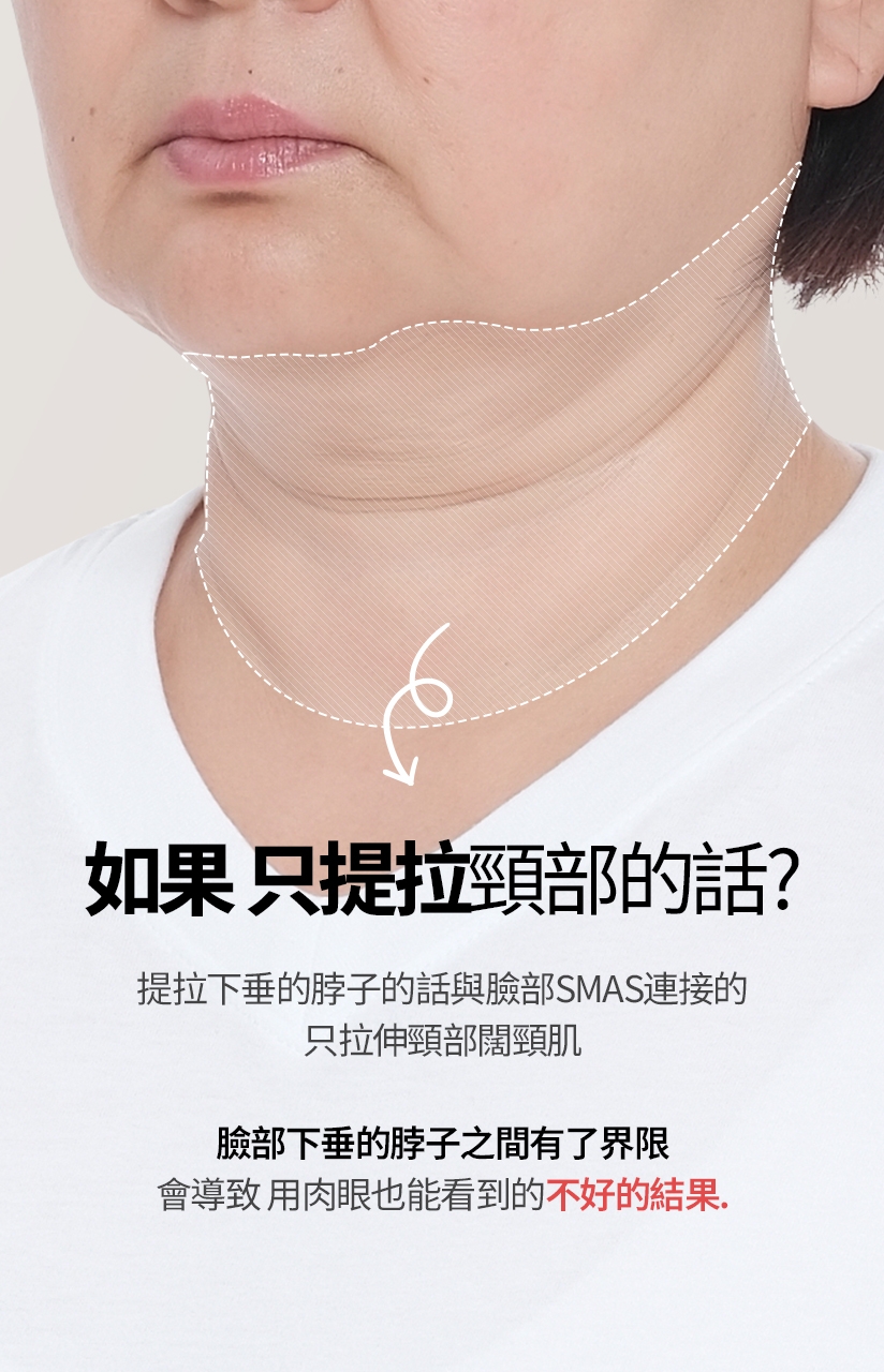 如果 只提拉 頸部的話？提拉下垂的脖子的話 與臉部SMAS連接的 只拉伸頸部闊頸肌，臉部下垂的脖子之間有了界限 會導致 用肉眼也能看到的 不好的結果