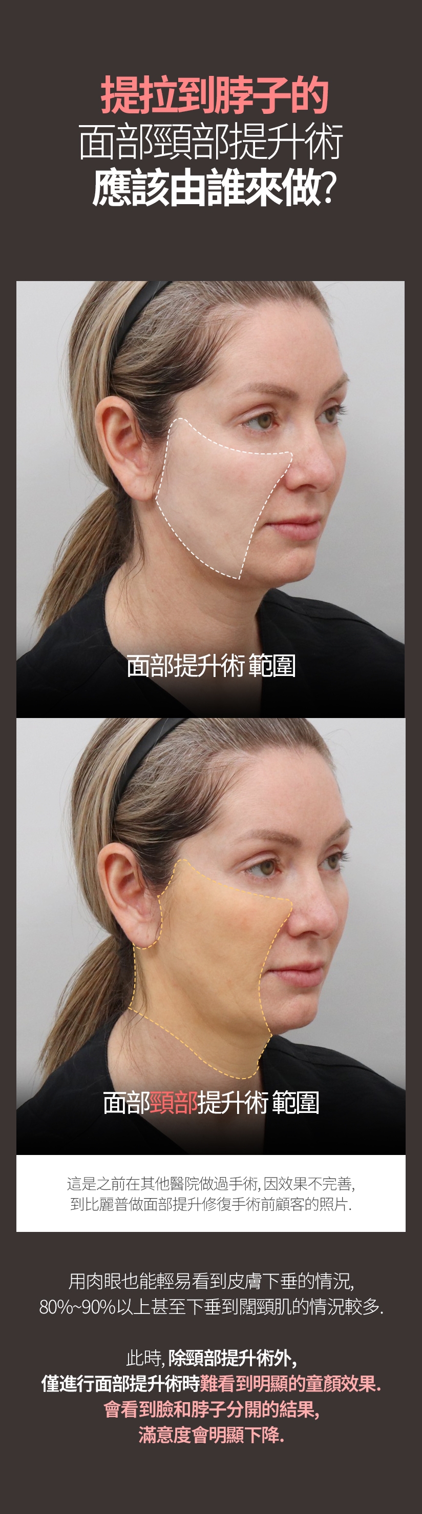 提拉到脖子的 面部頸部提升術 應該由誰來做？ 面部提升術 範圍 面部頸部提升術 範圍 這是之前在其他醫院做過手術， 因效果不完善，到比麗普做面部提升修復手術前顧客的照片 用肉眼也能輕易看到皮膚下垂的情況、80%~90%以上甚至下垂到闊頸肌的情況較多 此時，除頸部提升術外，僅進行面部提升術時，很難看到明顯的童顏效果。會看到臉和脖子分開的結果，滿意度會明顯下降。