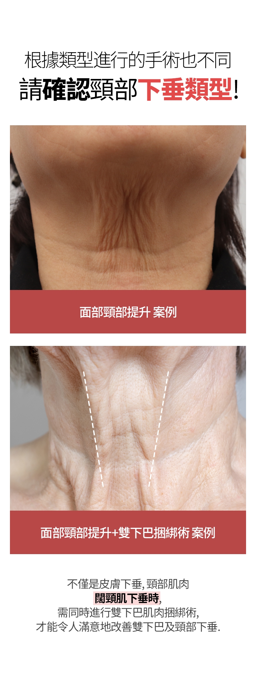 根據類型進行的手術也不同 請確認頸部下垂類型！ 面部頸部提升 案例 面部頸部提升+雙下巴捆綁術 案例 不僅是皮膚下垂，頸部肌肉闊頸肌下垂時，需同時進行雙下巴肌肉捆綁術，才能令人滿意地改善雙下巴及頸部下垂。