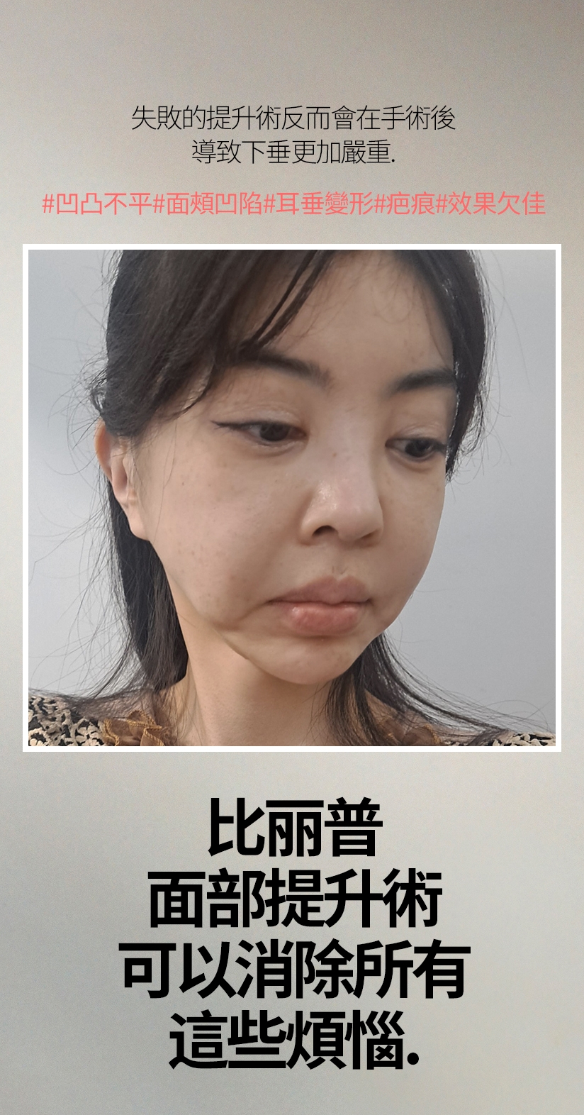 失敗的提升術反而會在手術後 導致下垂更加嚴重。#凹凸不平#面頰凹陷#耳垂變形#疤痕#效果欠佳 比麗普 面部提升術 可以消除所以 這些煩惱