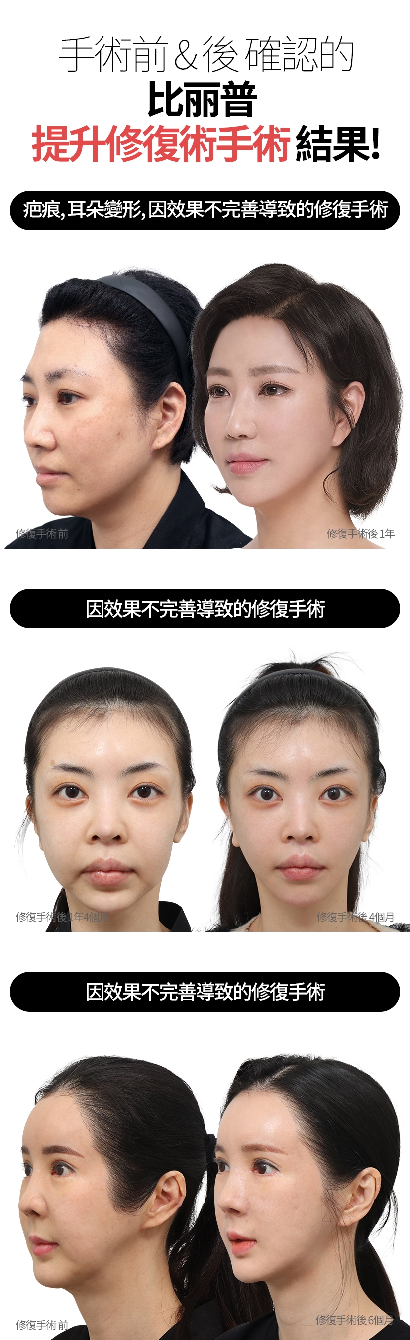 手術前&後 確認的 比丽普 提升修復術手術結果！ 疤痕，耳朵變形，因效果不完善導致的修復手術 因效果不完善導致的修復手術 因效果不完善導致的修復手術 修復手術 前 - 修復手術後 1年