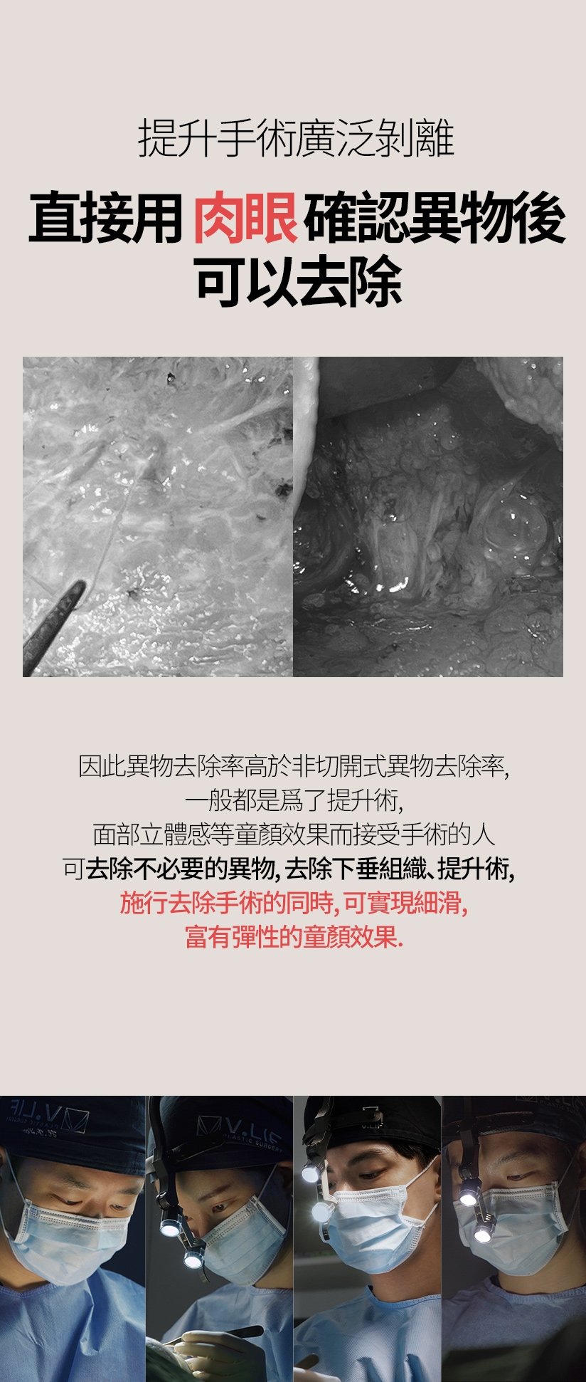 提升手術廣泛剝離 直接用肉眼確認異物後 可以去除 因此異物去除率高於非切開式異物去除率， 一般都是爲了提升術、面部立體感等童顏效果而接受手術的人 可去除不必要的異物、去除下垂組織、提升術，施行去除手術的同時，可實現細滑、富有彈性的童顏效果。 