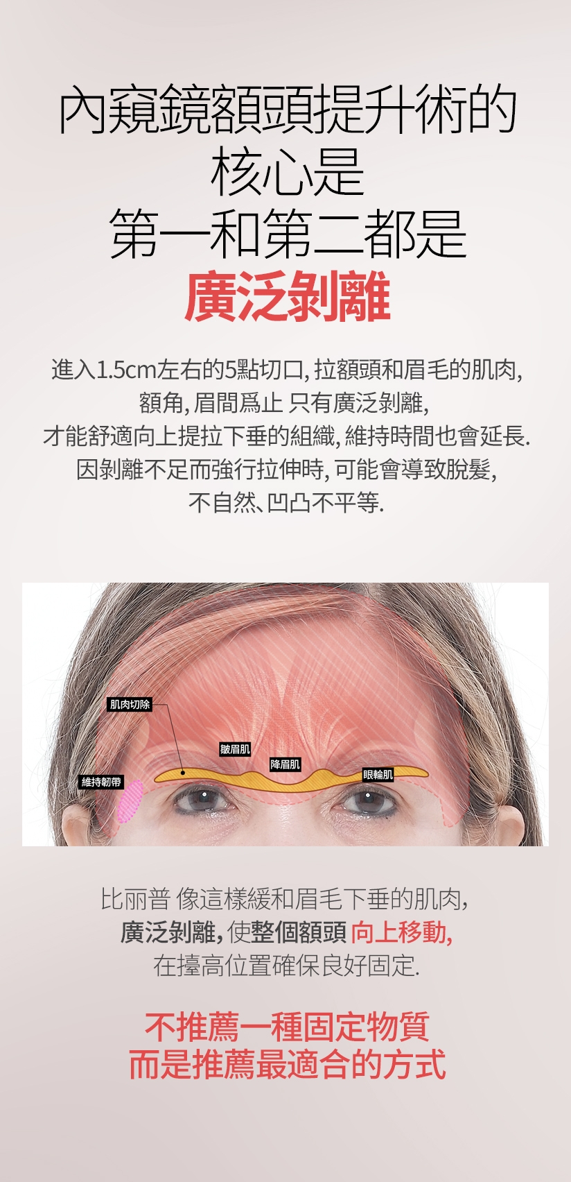 內窺鏡額頭提升術的核心是 第一和第二都是廣泛剝離 進入1.5cm左右的5點切口，拉額頭和眉毛的肌肉、額角、眉間爲止 只有廣泛剝離，才能舒適向上提拉下垂的組織，維持時間也會延長。因剝離不足而強行拉伸時，可能會導致脫髮、不自然、凹凸不平等。維持韌帶 肌肉切除 皺眉肌 降眉肌 眼輪肌 比丽普 像這樣緩和眉毛下垂的肌肉，廣泛剝離，使整個額頭向上移動，在擡高位置確保良好固定。不推薦一種固定物質 而是推薦最適合的方式