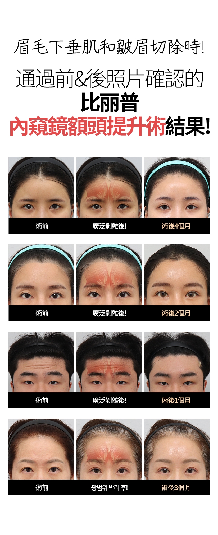 毛下垂肌和皺眉切除時！ 通過前&後照片確認的 比麗普內窺鏡額頭提升術結果