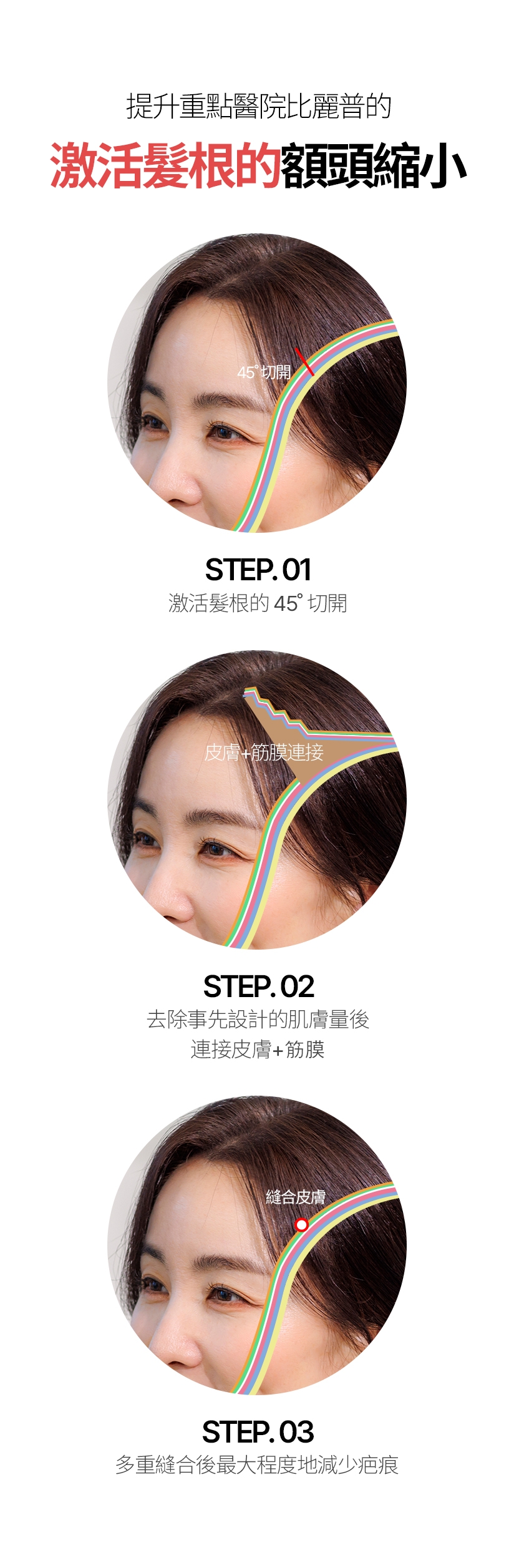 提升重點醫院比麗普的 激活髮根的額頭縮小 45 ˚  切開 - STEP.01 激活髮根的45切開, 皮膚+筋膜連接 - STEP.02 去除事先設計的肌膚量後 連接皮膚+筋膜, 縫合皮膚 - STEP.03 多重縫合後最大程度地減少疤痕