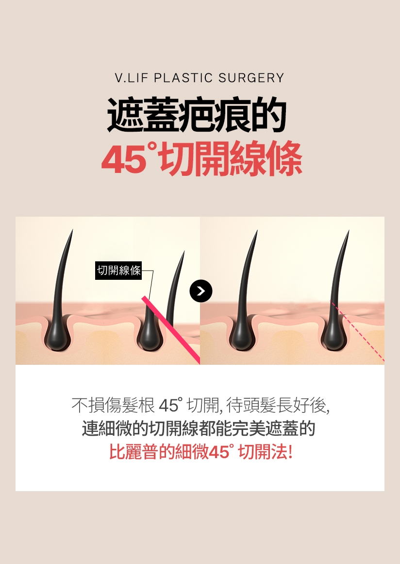 遮蓋疤痕的 45 ˚ 切開線條 切開線條 不損傷髮根，45 切開，待頭髮長好後， 連細微的切開線都能完美遮蓋的 比麗普的細微45切開法
