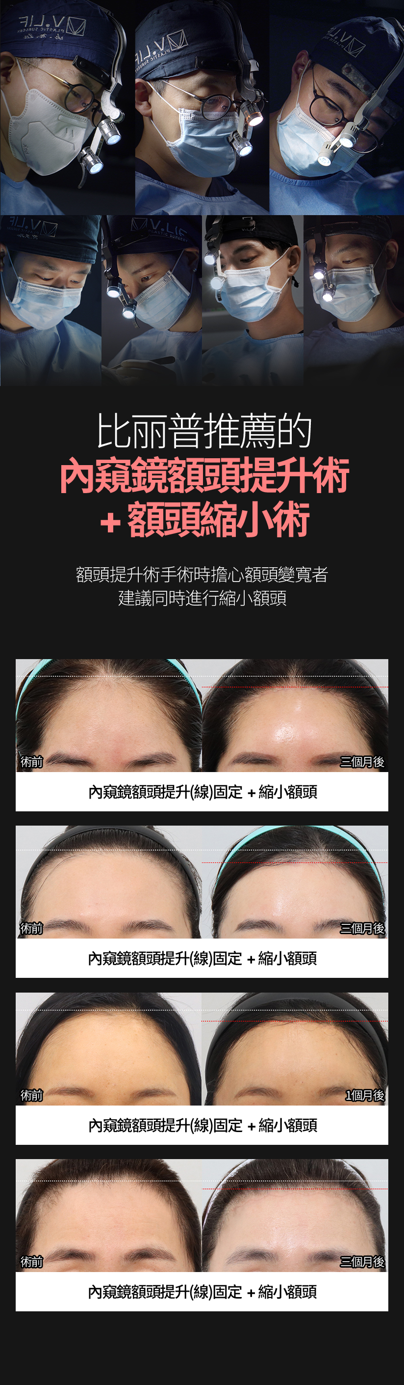 比麗普推薦的 內窺鏡額頭提升術+額頭縮小術 額頭提升術手術時擔心額頭變寬者 建議同時進行縮小額頭 內窺鏡額頭提升（線）固定 + 縮小額頭 內窺鏡額頭提升（線）固定 + 縮小額頭 內窺鏡額頭提升（線）固定 + 縮小額頭 內窺鏡額頭提升（線）固定 + 縮小額頭