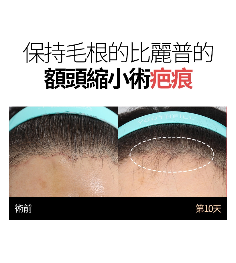 保持毛根的比麗普的 額頭縮小術疤痕 術前 第10天