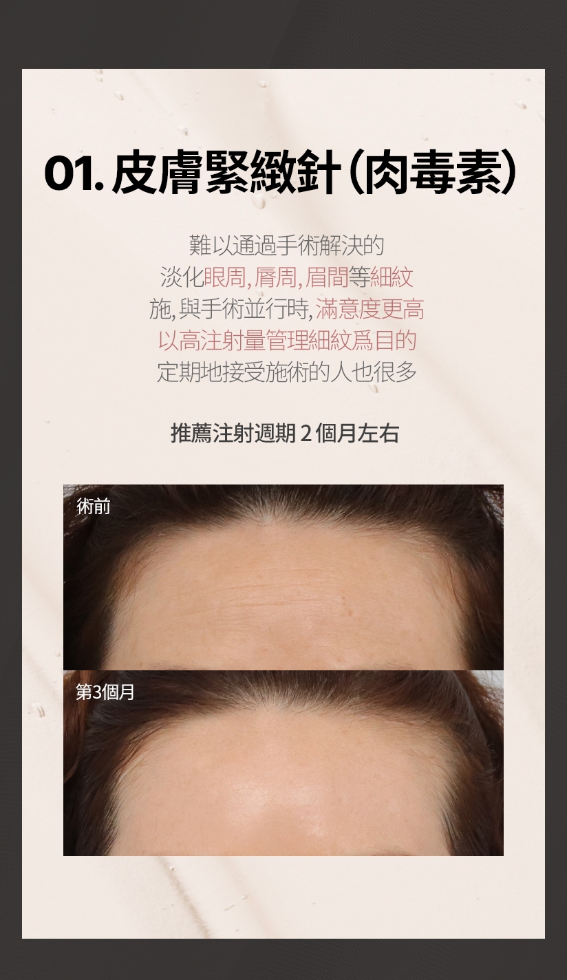 01. 皮膚緊緻針（肉毒素） 難以通過手術解決的 淡化眼周、脣周、眉間等細紋 施，與手術並行時，滿意度更高 以高注射量管理細紋爲目的 定期地接受施術的人也很多 推薦注射週期 2 個月左右