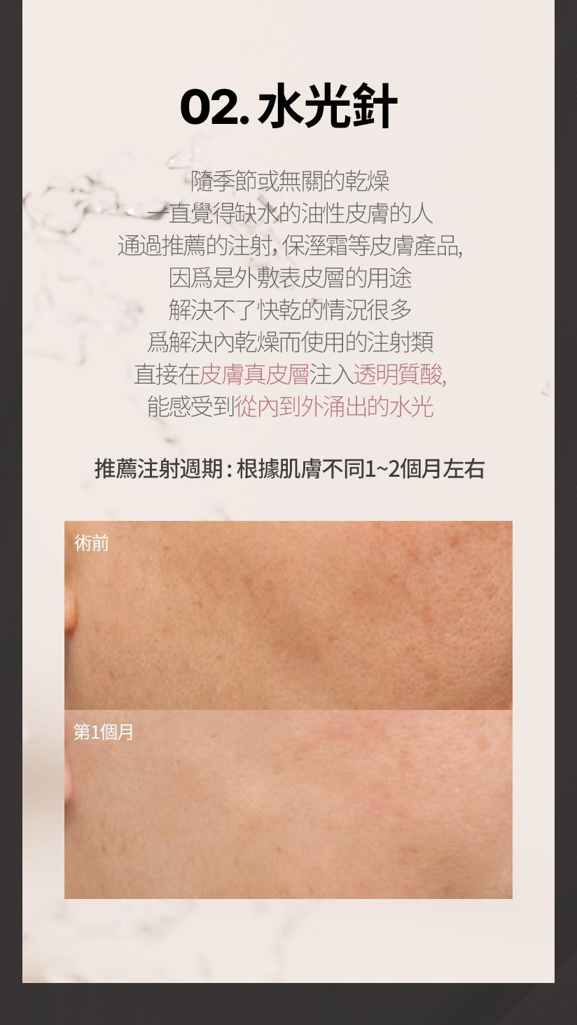 02. 水光針 隨季節或無關的乾燥 一直覺得缺水的油性皮膚的人 通過推薦的注射，保溼霜等皮膚產品， 因爲是外敷表皮層的用途 解決不了快乾的情況很多 爲解決內乾燥而使用的注射類 直接在皮膚真皮層注入透明質酸，能感受到從內到外涌出的水光 推薦注射週期: 根據肌膚不同1~2個月左右
