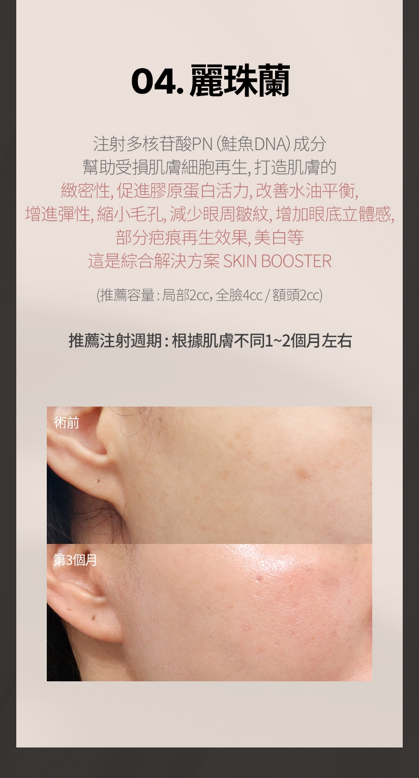 04. 麗珠蘭 注射多核苷酸PN（鮭魚DNA）成分 幫助受損肌膚細胞再生，打造肌膚的 緻密性、促進膠原蛋白活力、改善水油平衡、 增進彈性、縮小毛孔、減少眼周皺紋、增加眼底立體感、 部分疤痕再生效果、美白等 這是綜合解決方案 SKIN BOOSTER 推薦容量: 局部2cc，全臉4cc / 額頭2cc 推薦注射週期: 根據肌膚不同1~2個月左右