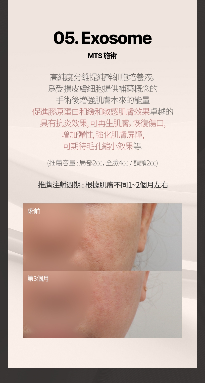 05. Exosome MTS 施術 高純度分離提純幹細胞培養液， 爲受損皮膚細胞提供補藥概念的 手術後增強肌膚本來的能量 促進膠原蛋白和緩和敏感肌膚效果卓越的 具有抗炎效果，可再生肌膚，恢復傷口， 增加彈性、強化肌膚屏障、 可期待毛孔縮小效果等。推薦容量: 局部2cc，全臉4cc / 額頭2cc 推薦注射週期: 根據肌膚不同1~2個月左右