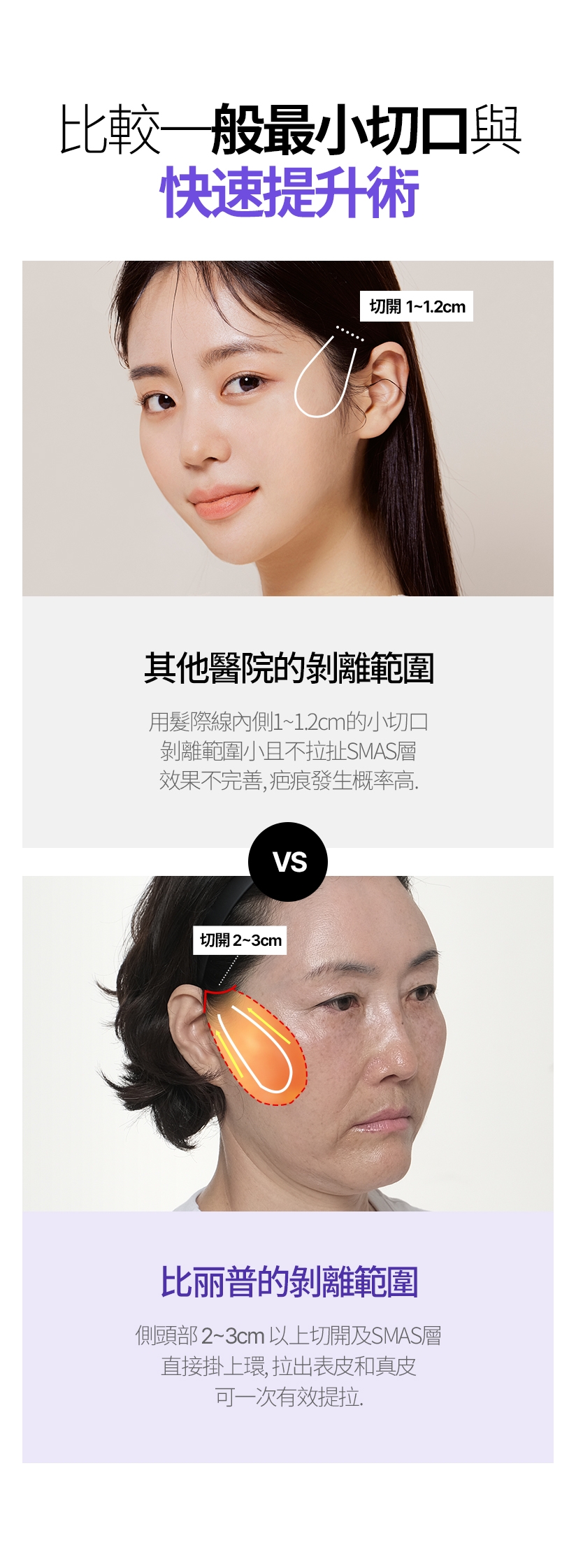 比較一般最小切口與快速提升術 切開1~1.2cm - 其他醫院的剝離範圍 用髮際線內側1~1.2cm的小切口 剝離範圍小且不拉扯SMAS層 效果不完善，疤痕發生概率高。/ 切開2~3cm - 比丽普的剝離範圍 側頭部2~3cm以上切開及SMAS層 直接掛上環，拉出表皮和真皮 可一次有效提拉