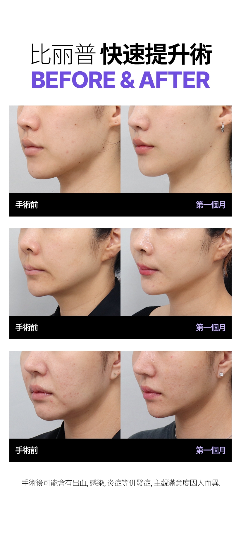 比丽普 快速提升術 BEFORE & AFTER 手術後可能會有出血、感染、炎症等併發症，主觀滿意度因人而異。