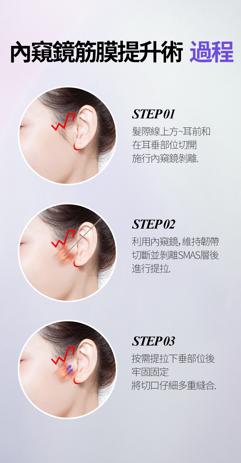 內窺鏡筋膜提升術 過程 STEP 01 髮際線上方~耳前和 在耳垂部位切開 施行內窺鏡剝離 / STEP 02 利用內窺鏡，維持韌帶 切斷並剝離SMAS層後 進行提拉 / STEP 03 按需提拉下垂部位後 牢固固定 將切口仔細多重縫合