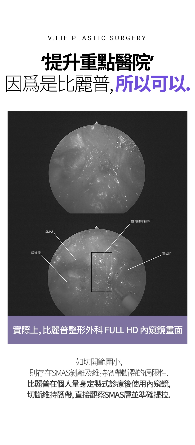 提升重點醫院 因爲是比麗普，所以可以。實際上，比麗普整形外科 FULL HD 內窺鏡畫面 如切開範圍小，則存在SMAS剝離及維持韌帶斷裂的侷限性。 比麗普在個人量身定製式診療後使用內窺鏡，切斷維持韌帶，直接觀察SMAS層並準確提拉。